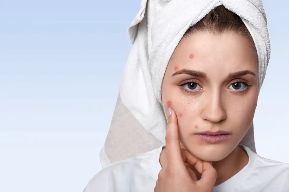 How to Get Rid of Pimples Naturally and Permanently?